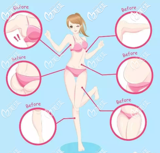 5G天使光雕适合的吸脂部位 5G天使光雕适合的吸脂部位