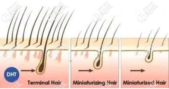 什么是遗传性脱发