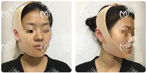 下颌角整形手术恢复1个月