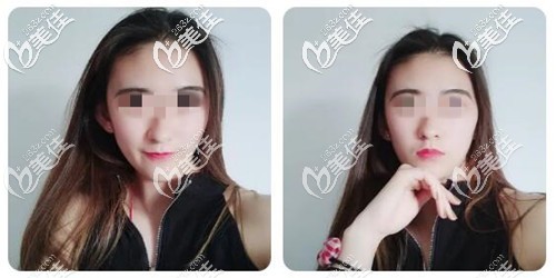 下颌角整形手术恢复三个月