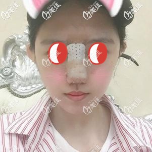 鼻综合术后即刻鼻子变挺拔