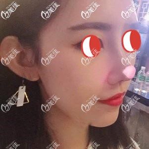 隆鼻术后25天鼻子肿胀基本消完