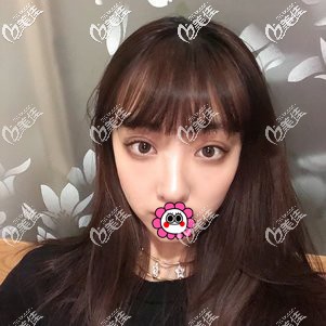 温州芘丽芙双眼皮恢复一个月效果