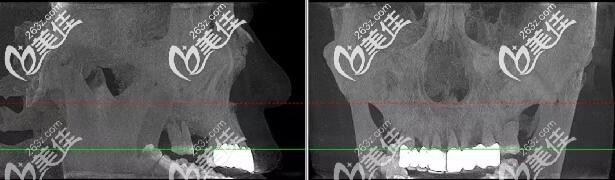 杭州美奥口腔穿颧种植牙案例