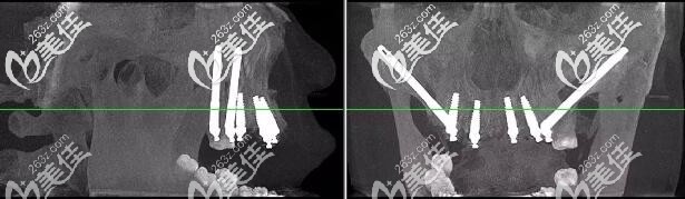 杭州美奥口腔半口穿颧种植牙案例