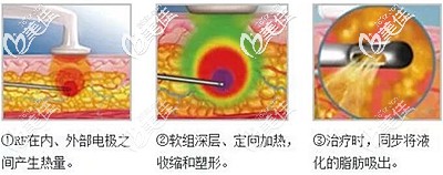 黄金微雕瘦脸的原理 黄金微雕瘦脸的原理