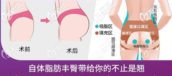 自体脂肪丰臀前后对比照片