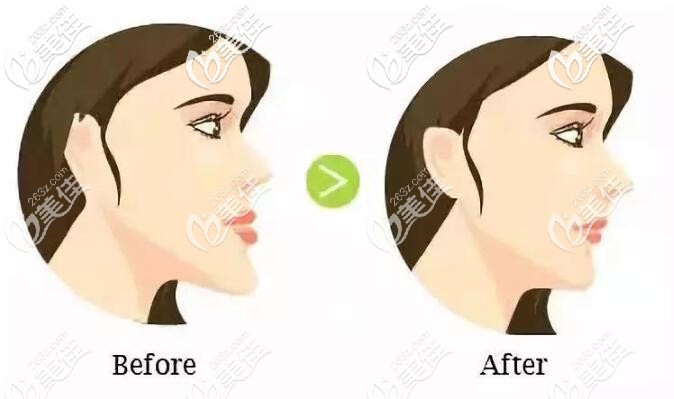 牙性加骨性地包天矫正前后差异 牙性加骨性地包天矫正前后差异