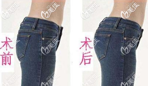 臀部抽脂手术前后照片
