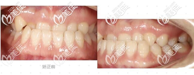 杭州齐尔口腔牙性加骨性地包天整牙前照片 杭州齐尔口腔牙性加骨性地包天整牙前照片