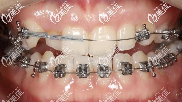 牙齿矫正刚戴牙套的照片 牙齿矫正刚戴牙套的照片
