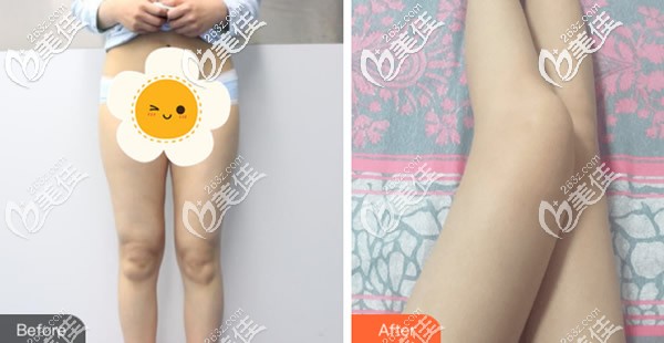 大腿吸脂前后对比照片