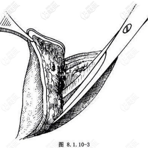 真皮脂肪瓣隆鼻 真皮脂肪瓣隆鼻