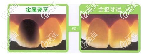 烤瓷牙和全瓷牙区别图 烤瓷牙和全瓷牙区别图