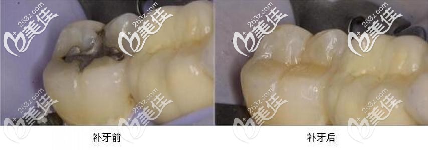 补牙前后对比图 补牙前后对比图