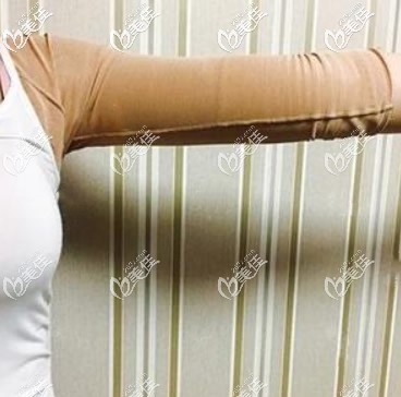 兰州时光胳膊吸脂7天恢复图