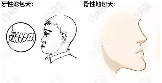牙性和骨性地包天区别图 牙性和骨性地包天区别图