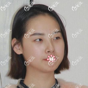 原来我单眼皮肿炮眼 原来我单眼皮肿炮眼