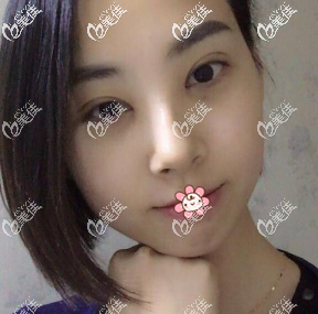 拆完线了 拆完线了