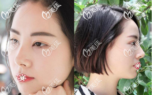 重庆光博士全切双眼皮一个月 重庆光博士全切双眼皮一个月