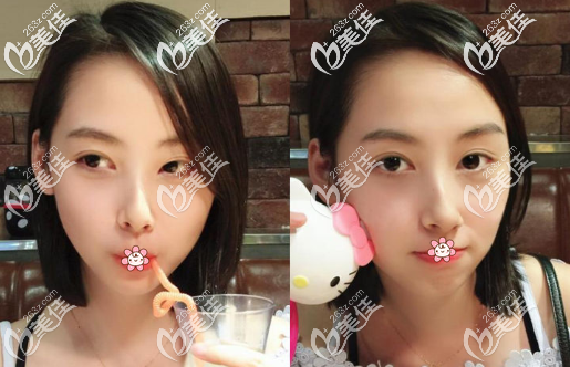 看完重庆这家做的开扇型全切双眼皮+开内眼角图片就明白8mm双眼皮恢复好了多宽