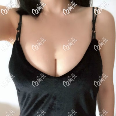 宝俪假体250cc隆胸三个月疗效图片 宝俪假体250cc隆胸三个月疗效图片