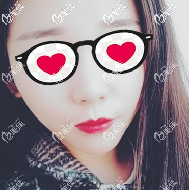 我在兰州崔大夫面部埋线提升7天恢复过程图片