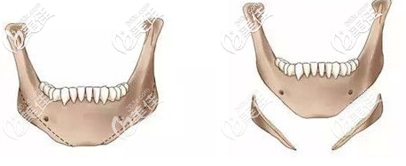 长曲线下颌角手术效果 长曲线下颌角手术效果