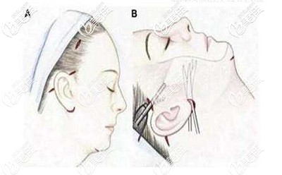 筋膜悬吊手术的原理 筋膜悬吊手术的原理