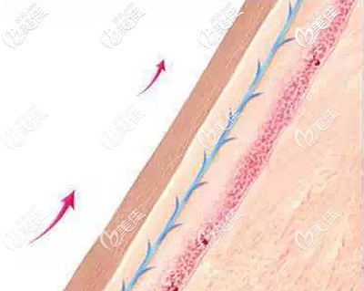 面部埋线提升的优势 面部埋线提升的优势