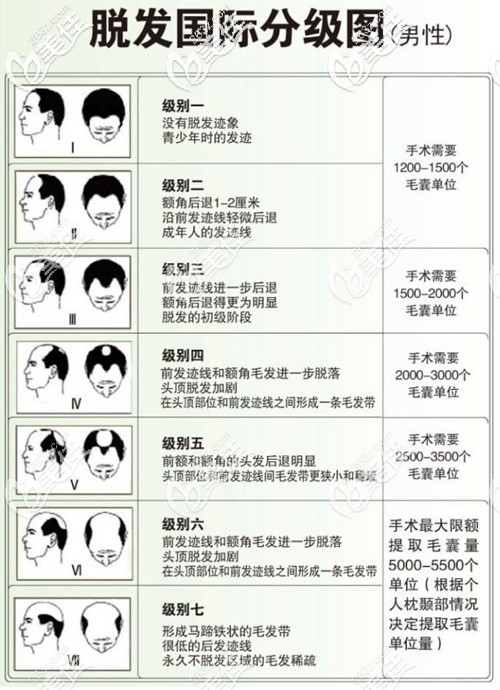 男性脱发等级分级图示 男性脱发等级分级图示