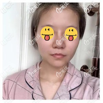做肋骨鼻综合前鼻头肥大、鼻梁宽 做肋骨鼻综合前鼻头肥大、鼻梁宽