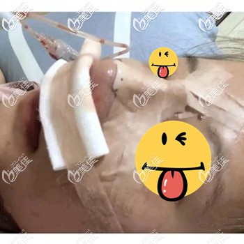 做完隆鼻手术当天鼻子不通气 做完隆鼻手术当天鼻子不通气