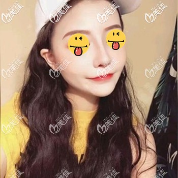 做完肋骨鼻因为肿胀鼻梁会感觉有点高 做完肋骨鼻因为肿胀鼻梁会感觉有点高