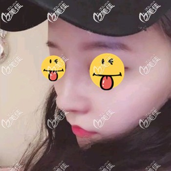 一位做肋骨鼻综合已经维持1年的朋友说恢复过程并没有别人说的那么痛苦