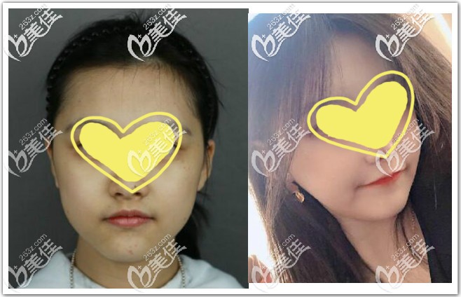 颧骨内推+下颌骨截骨手术恢复6个月效果图 颧骨内推+下颌骨截骨手术恢复6个月效果图