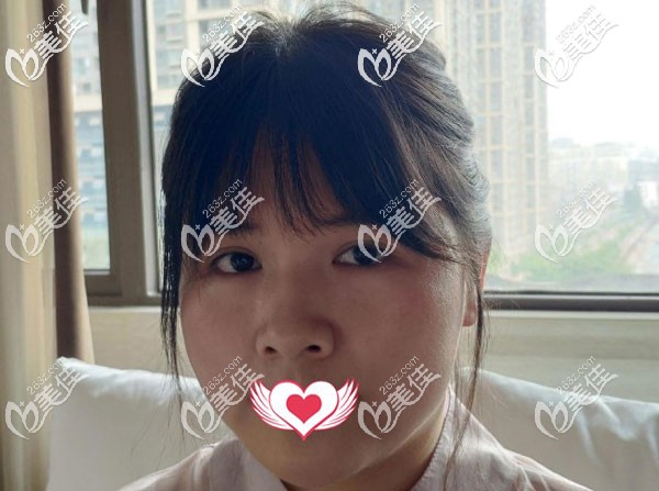 面部吸脂手术前 面部吸脂手术前