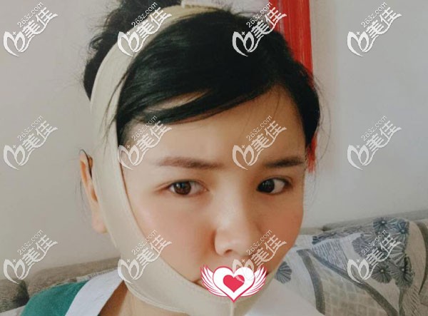 脸部吸脂第二天脸肿的厉害 脸部吸脂第二天脸肿的厉害