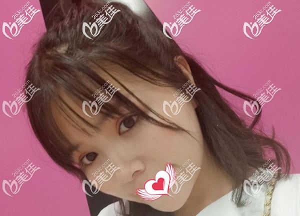 面部吸脂一个月轮廓已经显示出来了 面部吸脂一个月轮廓已经显示出来了