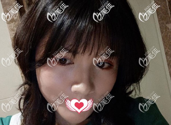 面部吸脂术后40天脸颊的脂肪已经掉下来了 面部吸脂术后40天脸颊的脂肪已经掉下来了