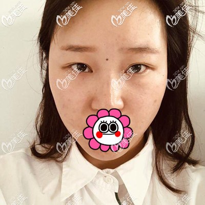 做完手术一个星期照片 做完手术一个星期照片