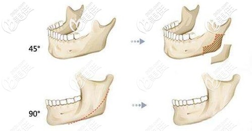 磨骨和削骨的区别