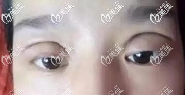 全切双眼皮失败照片