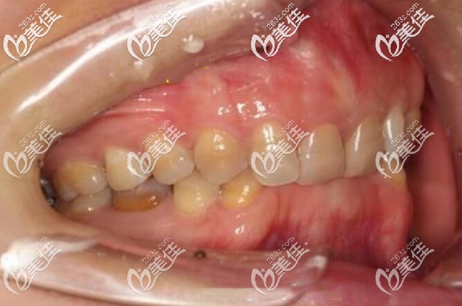 我的闭锁性深覆合牙齿图 我的闭锁性深覆合牙齿图