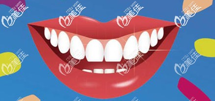 “一日得”种植牙的特点
