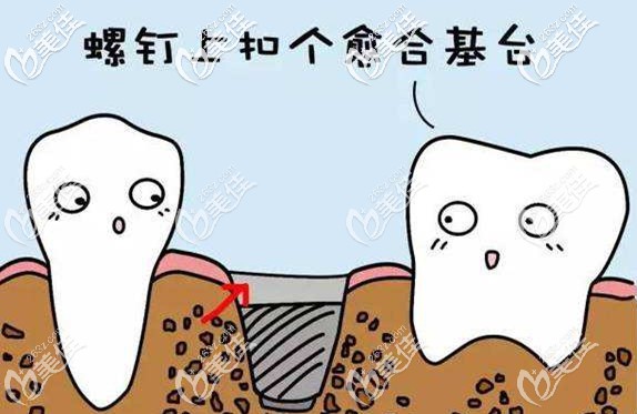 无需等待，当天拔牙当天种植