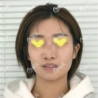 做美国舒铂鼻术前照片