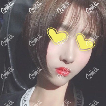 做美国舒铂鼻恢复三个月效果图片