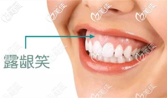 周洪医生浅谈关于笑露牙龈的矫治方法