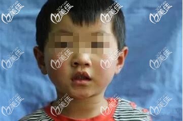 轻微隐形唇裂不做手术将来会后悔那么单侧轻度唇裂得做几次手术才会好